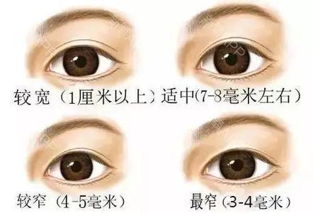 双眼皮手术,留疤,怎么处理