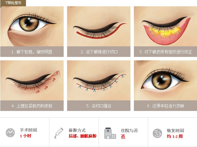 提眉术,切眉术,有什么,区别