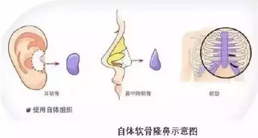 隆鼻、注射、假体、自体软骨