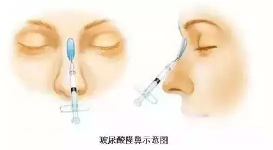 隆鼻、注射、假体、自体软骨