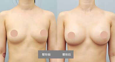 自体脂肪丰胸术前准备有哪些