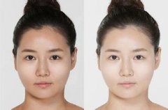 彩光嫩肤对肌肤会不会有副作用