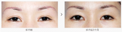 双眼皮手术修复前后对比图片