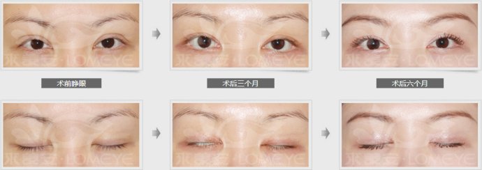 割双眼皮不好看怎么办