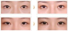 双眼皮修复手术果图