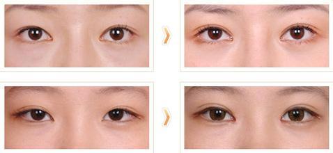 双眼皮修复手术果图