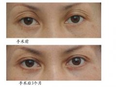 修复失败双眼皮手术要怎么做