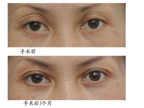 修复失败双眼皮手术要怎么做