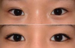 双眼皮失败修复优势