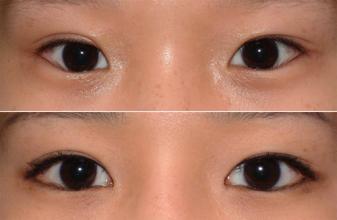 双眼皮失败修复优势