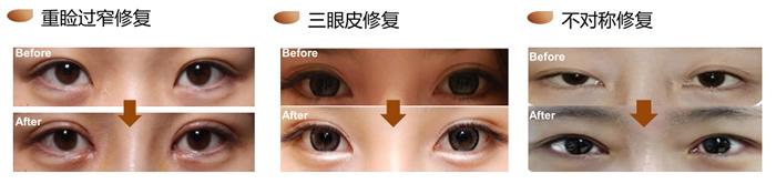 双眼皮失败修复对比照片