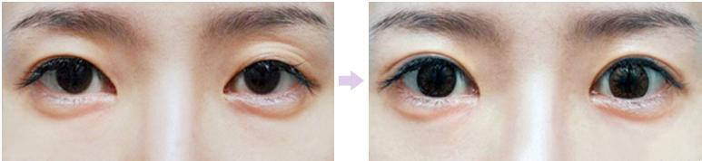 双眼皮失败的补救方法