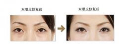 修复失败双眼皮方法