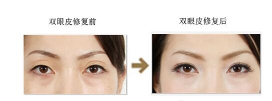 修复失败双眼皮方法