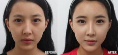 提眉术后全过程照片