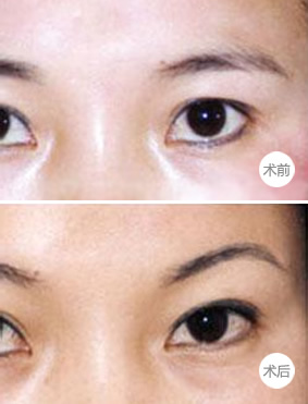 提眉手术前后的照片