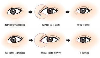 开内眼角,使眼睛变大