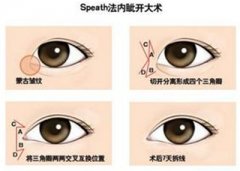 开内眼角疼吗