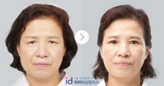 提眉手术后注意事项