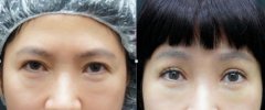 提眉手术图片