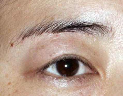 眉毛整形前后对比