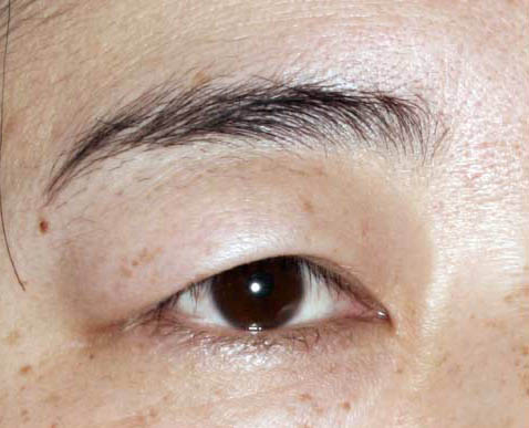 眉毛整形前后对比