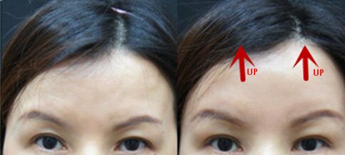 眉毛整形前后对比