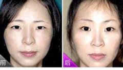 全新眉毛美容整形图片