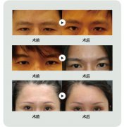 提眉手术前后的照片