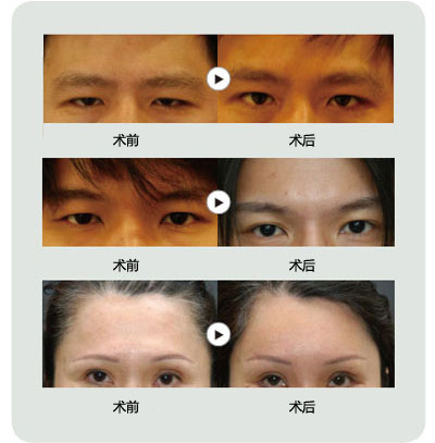 提眉手术前后的照片