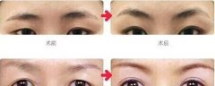 专业切眉提眉