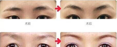 专业切眉提眉
