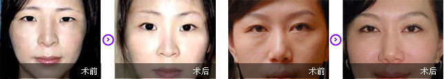 提眉手术果对比图