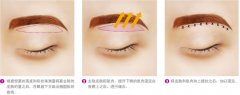 提眉术适合什么人