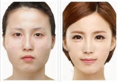 提眉手术方法有哪些