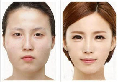 提眉手术方法有哪些