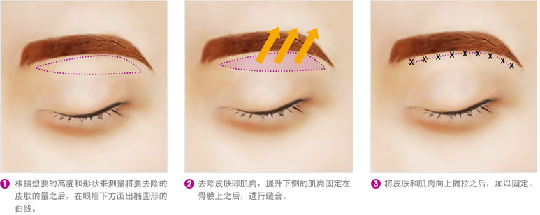 提眉手术方法有哪些