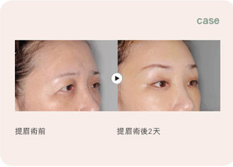 提眉手术方法有哪些