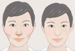 颧骨手术有什么副作用