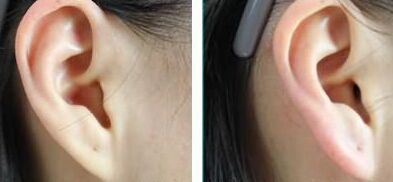 玻尿酸注射丰耳垂好吗