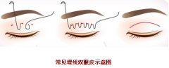 月经期能做埋线双眼皮吗