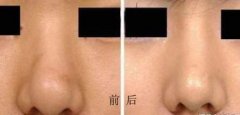 鼻头缩小术是怎么做的 鼻头缩小术恢复时间有多久
