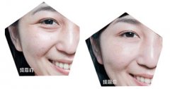 提眉切眉术前的注意事项