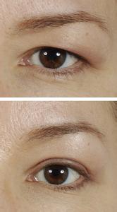 提眉切眉术前的注意事项