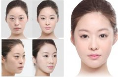 产生眼袋的几个原因 产生眼袋的几个原因
