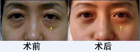 产生眼袋的几个原因