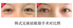 微创去眼袋果怎么样 微创去眼袋果怎么样