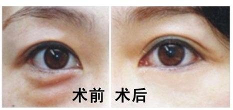 吸脂去眼袋果怎么样