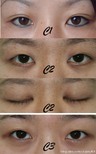 怎么修复挛缩性疤痕