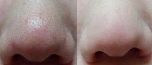 彩光嫩肤去黑头的成好吗